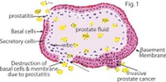 prostatitis and elevated psa